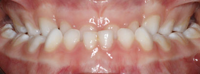 Teath Before Teath Before